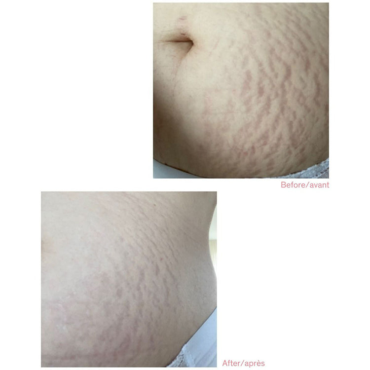 Liercac Phytolastil Stretch Mark Correction Concentrate